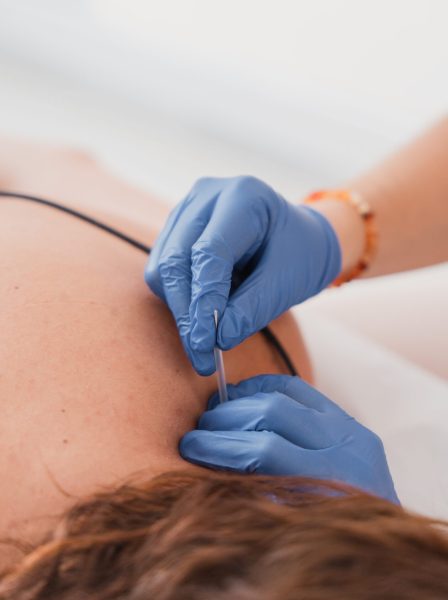 dry needling
